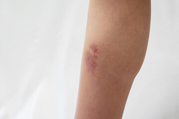 蜂窩織炎（蜂巣炎）の症状が出ている足のふくらはぎ内側
