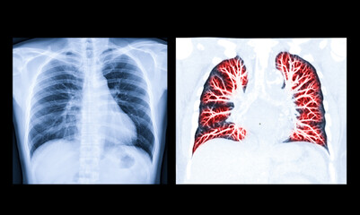 Chest X-ray or X-Ray Image Of Human Chest or Lung  Lateral view( red zone ) showing tuberculosis