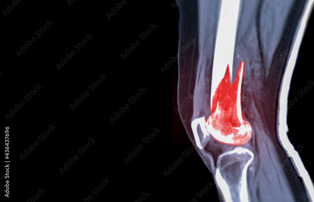 Poster ct knee 3d rendering image lateral view isolated on black background showing fracture femur bone.