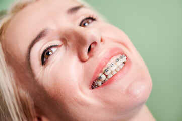 Close up of cheerful woman with orthodontic brackets on teeth. Female patient lying in dental...