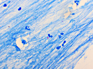 Mycobacterium tuberculosis positive (small red rod) in sputum smear, acid-fast stain, analyze by microscope 1000x