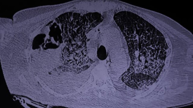 CAT-Scan video of a patient with SARS-Co-V2   COVID-19 and cavity with Aspergillus Fumigatus. Patient with tracheostomy tube.   