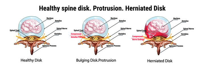 Healthy spine disk. Protrusion. Herniated Disk. Bulging Disk. The anatomical structure of the spine. Compressed nerve endings. Medical vector illustration.