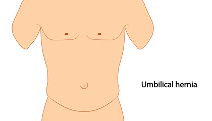 Umilical hernia anotomy illustration. Umbilical hernia placement.