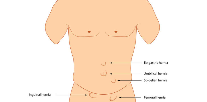 Types of hernia. Anatomy hernia illustration 