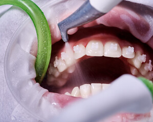 Macro photography. Top view on cleaning process in patient's mouth. Cleaning teeth with water jet...