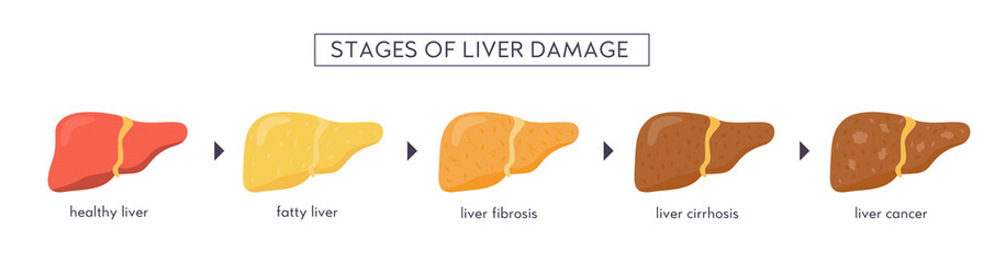 Stages of nonalcoholic liver damage. Healthy, fatty, steatosis, NASH, fibrosis, cirrhosis, cancer. Medical infographic of Liver Disease. Vector banner in flat cartoon style on white background. - obrazy, fototapety, plakaty