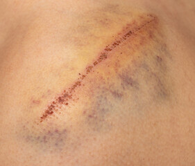 Fototapeta premium deep scratch with a bruise on the skin of the shoulder