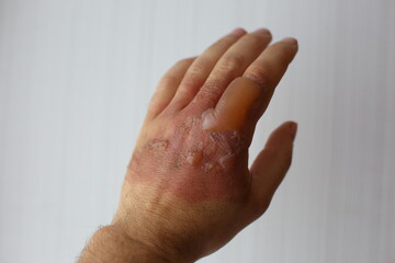 severe burn and blister on the hand, the palm burned with boiling water