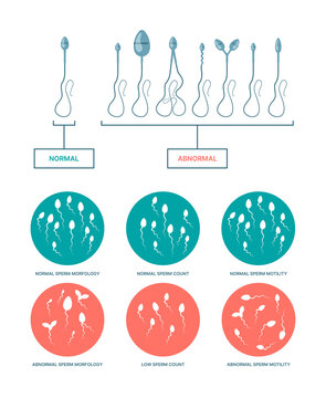 Spermogram. Medical infographic with healthy and damaged spermatozoa birth plan ovulation processes garish vector flat templates