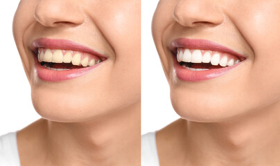 Fototapeta premium Collage with photos of woman before and after teeth whitening, closeup