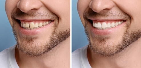 Collage with photos of man before and after teeth whitening, closeup. Banner design