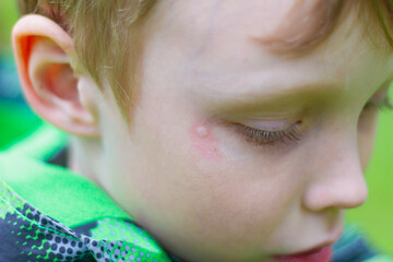 Mosquito bite mark on baby boy's face