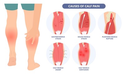 Calf Pain leg back muscle blood vessels nerve acute sport damage arterial trauma tennis soccer tear Cramp spasm Charley horses medial fiber bruising run walk tendon Clot deep vein pull torn up sprain