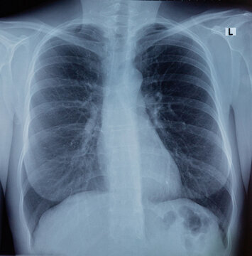 x-ray image of the human chest