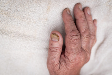 Fototapeta premium Nail fungus infection on the big finger. Fungal infection on nails hand, finger with onychomycosis.Closeup.