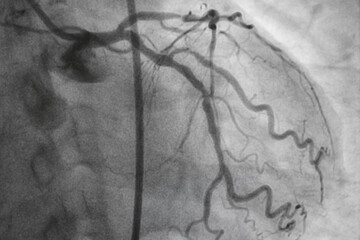 Coronary angiography, Coronary artery disease. Medical x-ray of heart disease. Healthcare and...