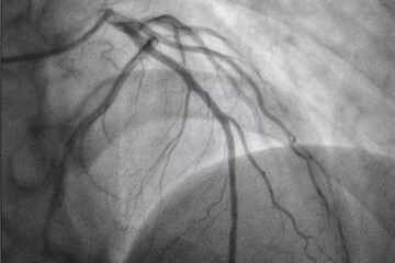 Coronary angiography, Coronary artery disease. Medical x-ray of heart disease. Healthcare and...