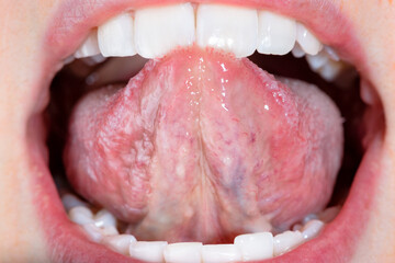 Anatomy of the underlying part of the tongue. Close-up of tongue above and below.