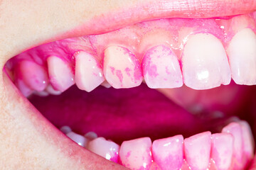Concept of deep and detailed cleaning of the teeth. Pink disclosing tablets or gel for reveal and...