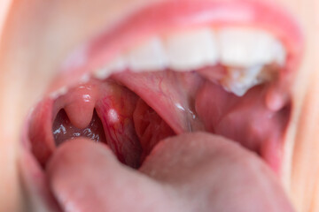 Close up on a canker sores. Inflammation of oral cavity. Very painful aphthae on uvula or soft...