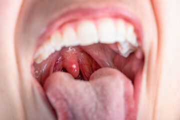 Close up on a canker sores. Inflammation of oral cavity. Very painful aphthae on uvula or soft...