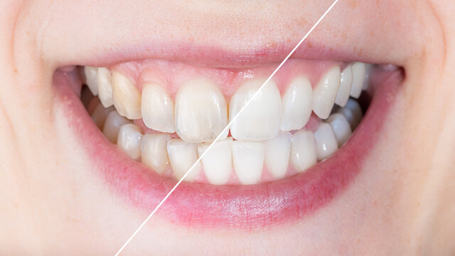Before and after whitening treatment or application of dental veneers. Concept of loss of teeth brightness and damaged tooth enamel. Transparency of the teeth caused by  demineralization.