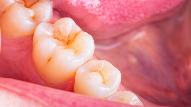 Symptoms of demineralization of the teeth. Visible signs of caries in the interstices of the enamel of  the tooth. Dental damaged erosion concept. Loss of the reinforcement of the enamel.