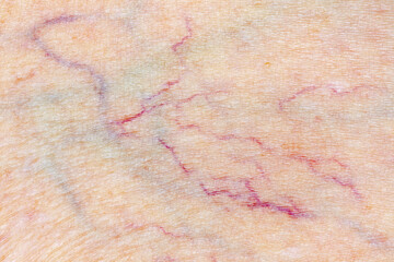 Varicose Vein for Phlebology, Skin Examination and Healthcare Macro Photo