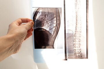 X-ray of the bones of the back of the vertebrae, lungs and chest in case of scoleosis and curvature...