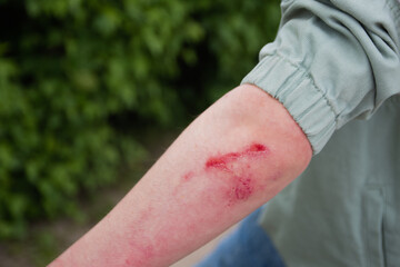 the man has a wound on his arm