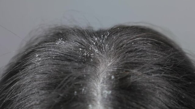 The concept of diseases of the scalp. Dirty dark hair with dandruff close-up. Top view. Movement along the parting of the hair.