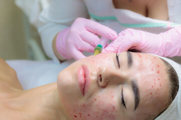 The doctor gives injections of blood plasma into the face of a young girl. Therapeutic procedure,...