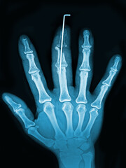 x ray of hand