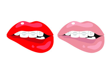 Dental braces, bright red and natural beige sexy female lips. Teeth, dentistry, orthodontics, medicine, health, beauty, aesthetics. Set of vector isolated illustrations on white background