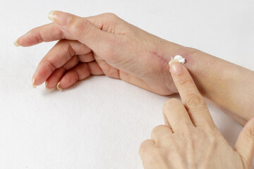 Applying a special medical cream or salve  to a healing scar after tendon surgery on a woman's...