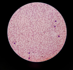 Microcytic hypochromic anaemia and immuno haemolytic anaemia, microscopic close view