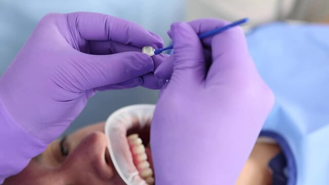 Dentist lubricating veneer with glue and installing on tooth