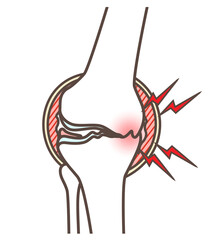 変形性膝関節症のイラスト
