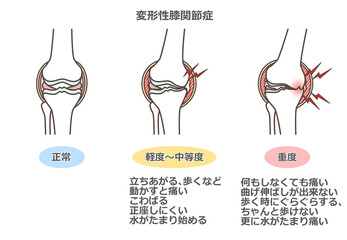 変形性膝関節症のイラスト