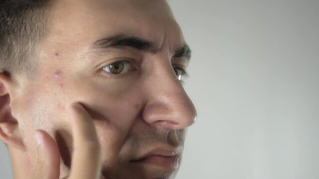 Worried adult man looks in mirror, examining acnes and zits on face. Unhappy man dissatisfied with skin condition. Adult person has problem skin with acnes and zits.