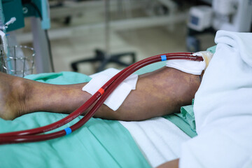 patient's leg with extracorporeal membrane oxygenation line (ECMO) on bed at critical care unit (CCU) - obrazy, fototapety, plakaty