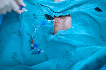 anesthetist setting central venous catheter to patient before open heart surgery - obrazy, fototapety, plakaty