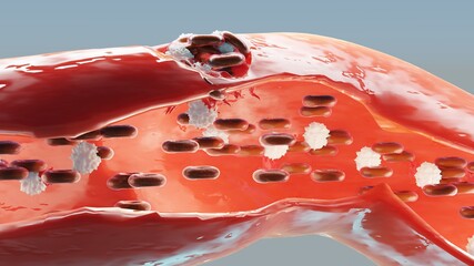 Hemostasis. Red blood cells and platelets in the blood vessel. Basic steps of wound healing process. 3d illustration - obrazy, fototapety, plakaty
