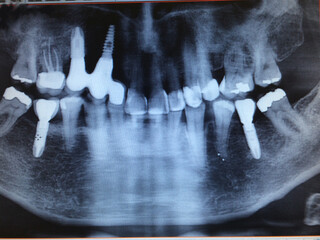 X-ray of person with multiple reconstructions of teeth, fillings and dental implants