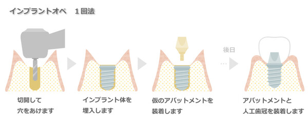 インプラントオペ（1回法）