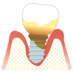 インプラント歯周炎（重度）