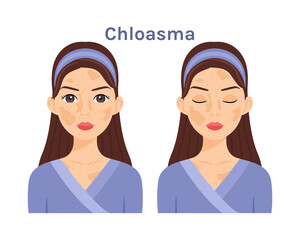 Fototapeta premium Chloasma.Isolated Beautiful Brunette woman. Cute face. Skin disease.Treatment.Woman with open eyes and closed. White background. Color Flat cartoon illustration.Poster.Vector stock illustration.