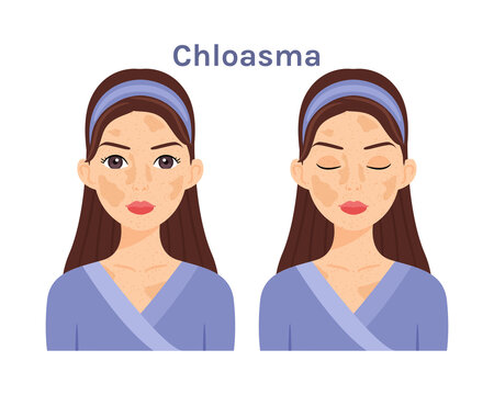 Chloasma.Isolated Beautiful Brunette woman. Cute face. Skin disease.Treatment.Woman with open eyes and closed. White background. Color Flat cartoon illustration.Poster.Vector stock illustration.
