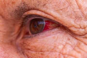 Close up of red eye or or bloodshot eyes which can be the sign of a minor irritation or a serious medical condition, such as an infection.noccur when small blood vessels that are present. - obrazy, fototapety, plakaty